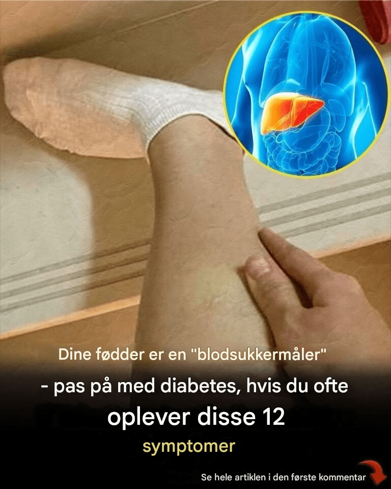 Dine fødder er en “blodsukkermåler” – Pas på diabetes, hvis du ofte oplever disse 12 symptomer