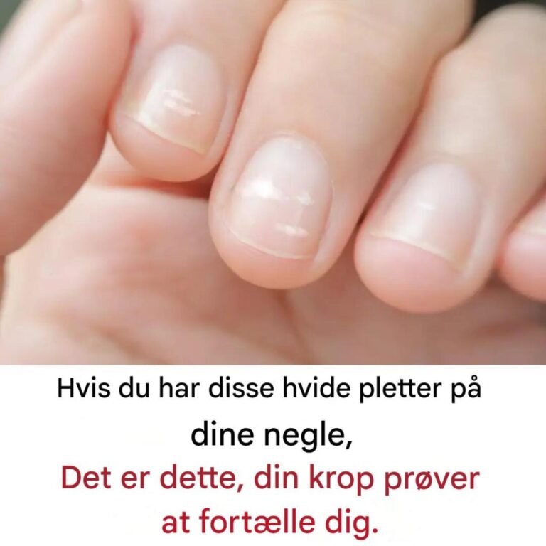 Hvorfor ser vi nogle gange hvide pletter på vores negle?