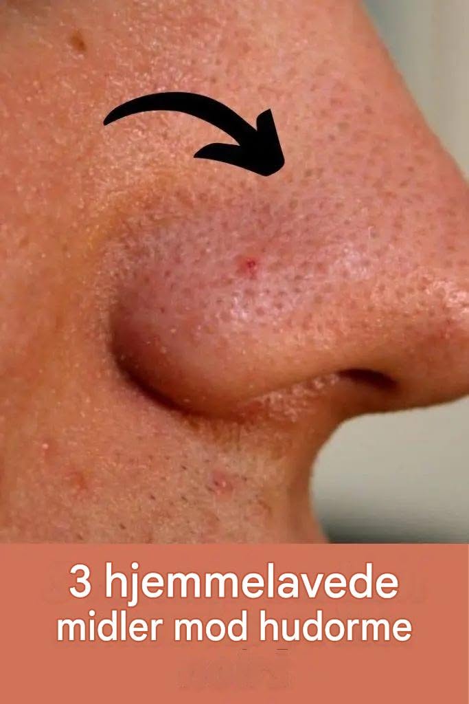 #3 Hjemmelavede opskrifter til hudorme