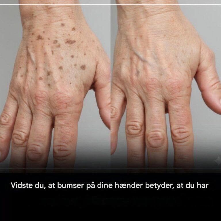 Vidste du, at hvis du har pletter på dine hænder, betyder det, at du har